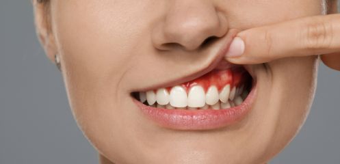 Chronic sore spots from ill-fitting plates